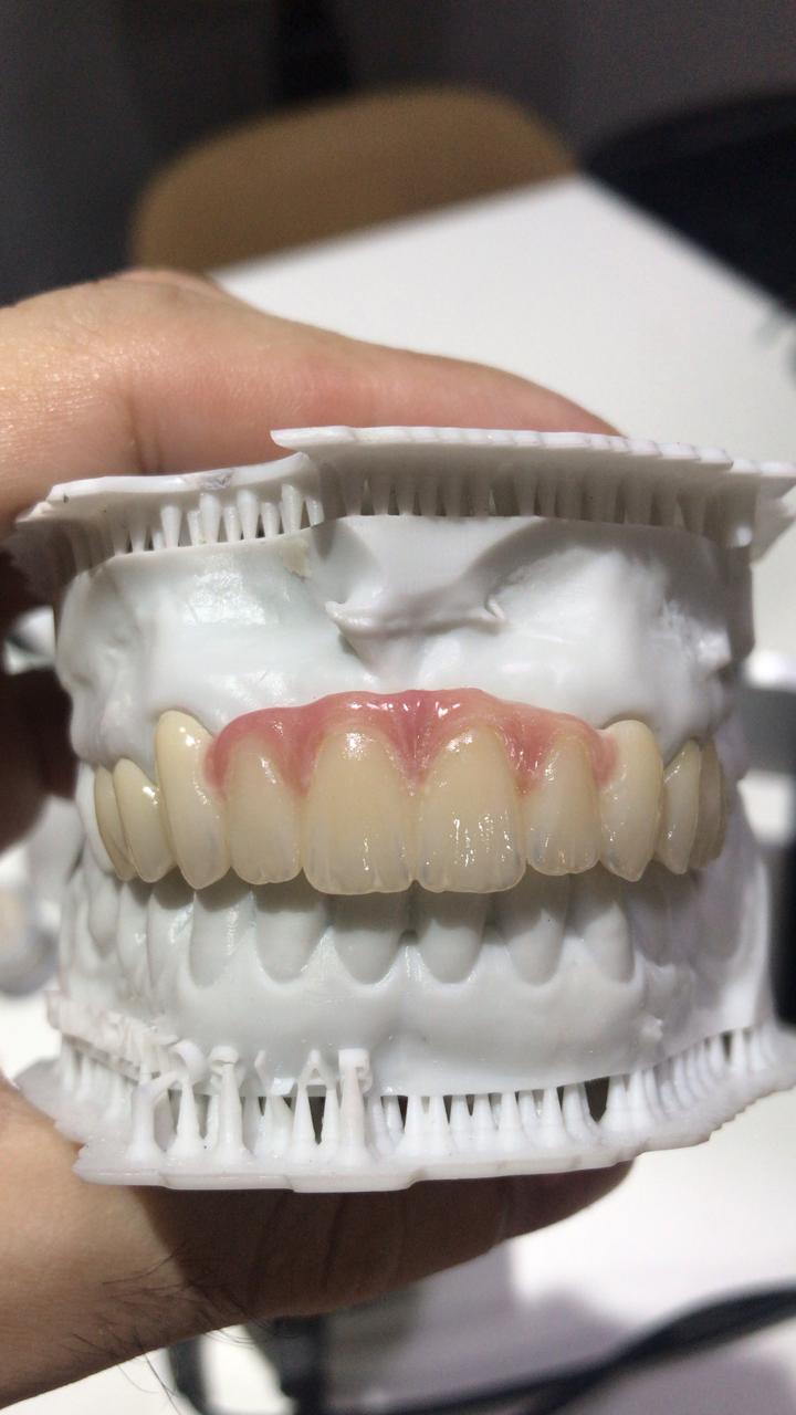 Fixa dentogengival